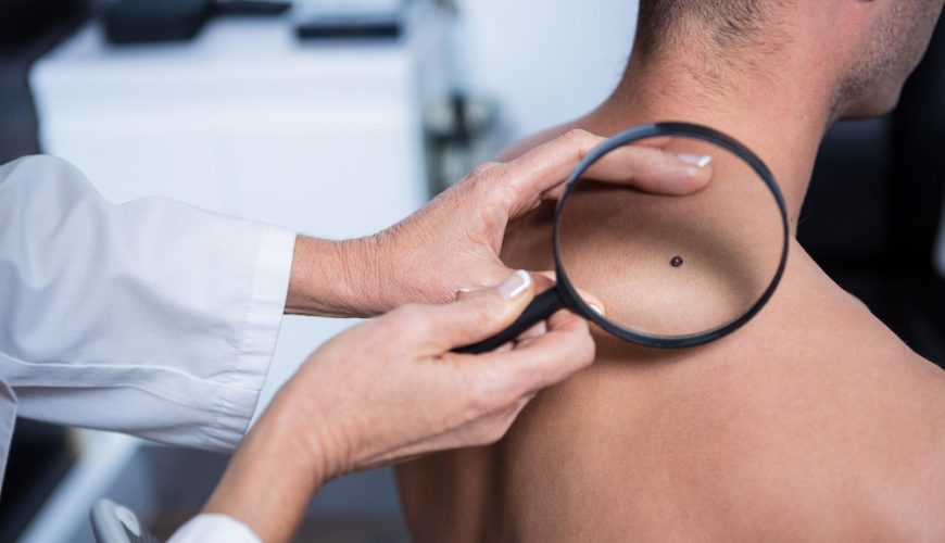 Doctora revisando con lupa a un paciente con cáncer de piel