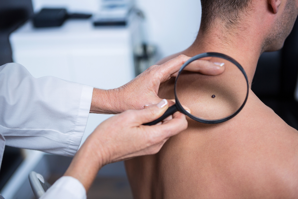 Doctora revisando con lupa a un paciente con cáncer de piel